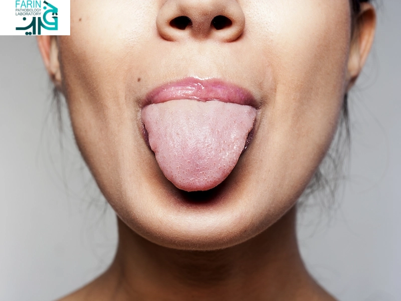 علائم کمبود ویتامین B روی زبان